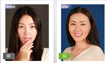 美式隐形正牙，不露痕迹重燃微笑！